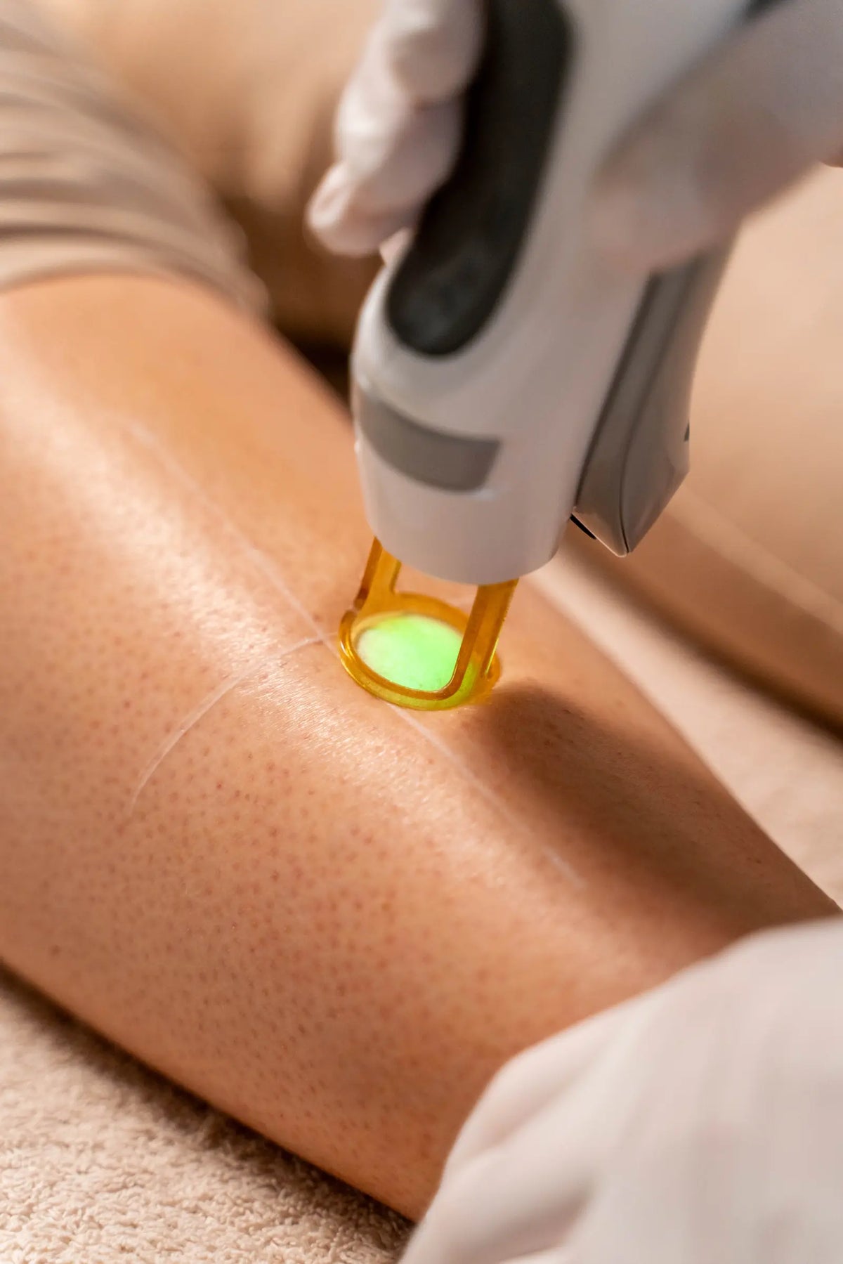 Laser ontharing